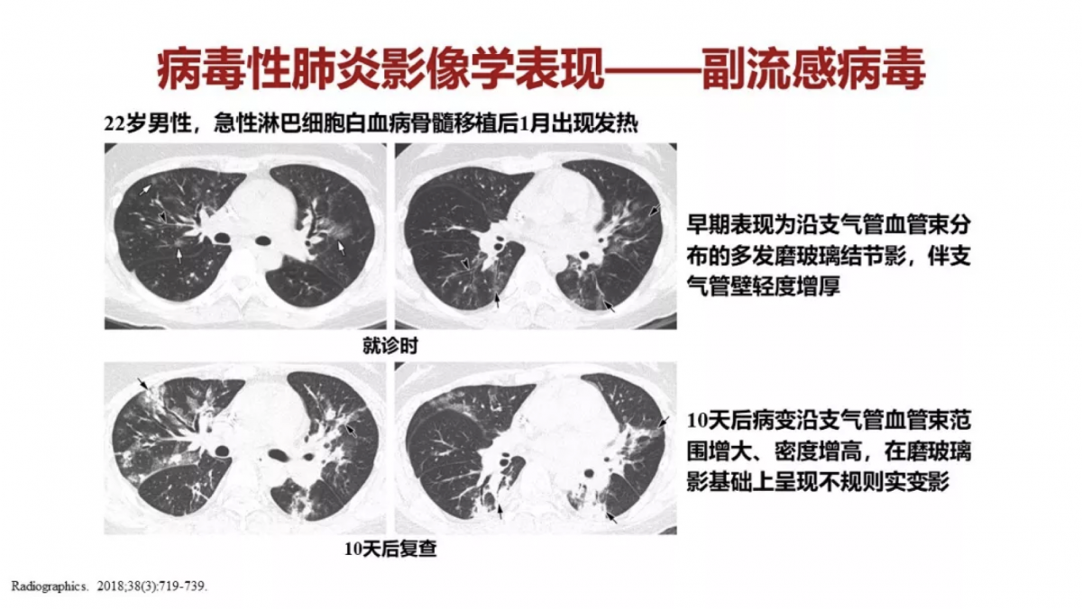 間 質 性 肺炎 急性 増悪